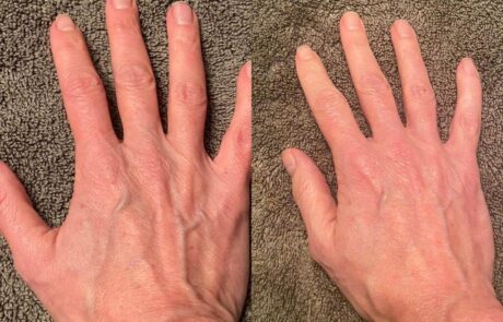 before after hand veins