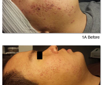 before after acne