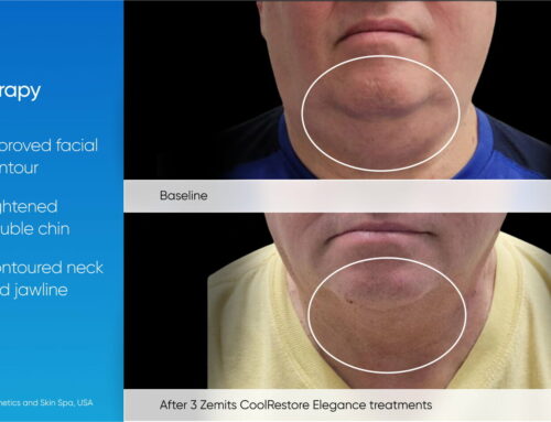 Cryo Slimming or Kybella for Double Chins