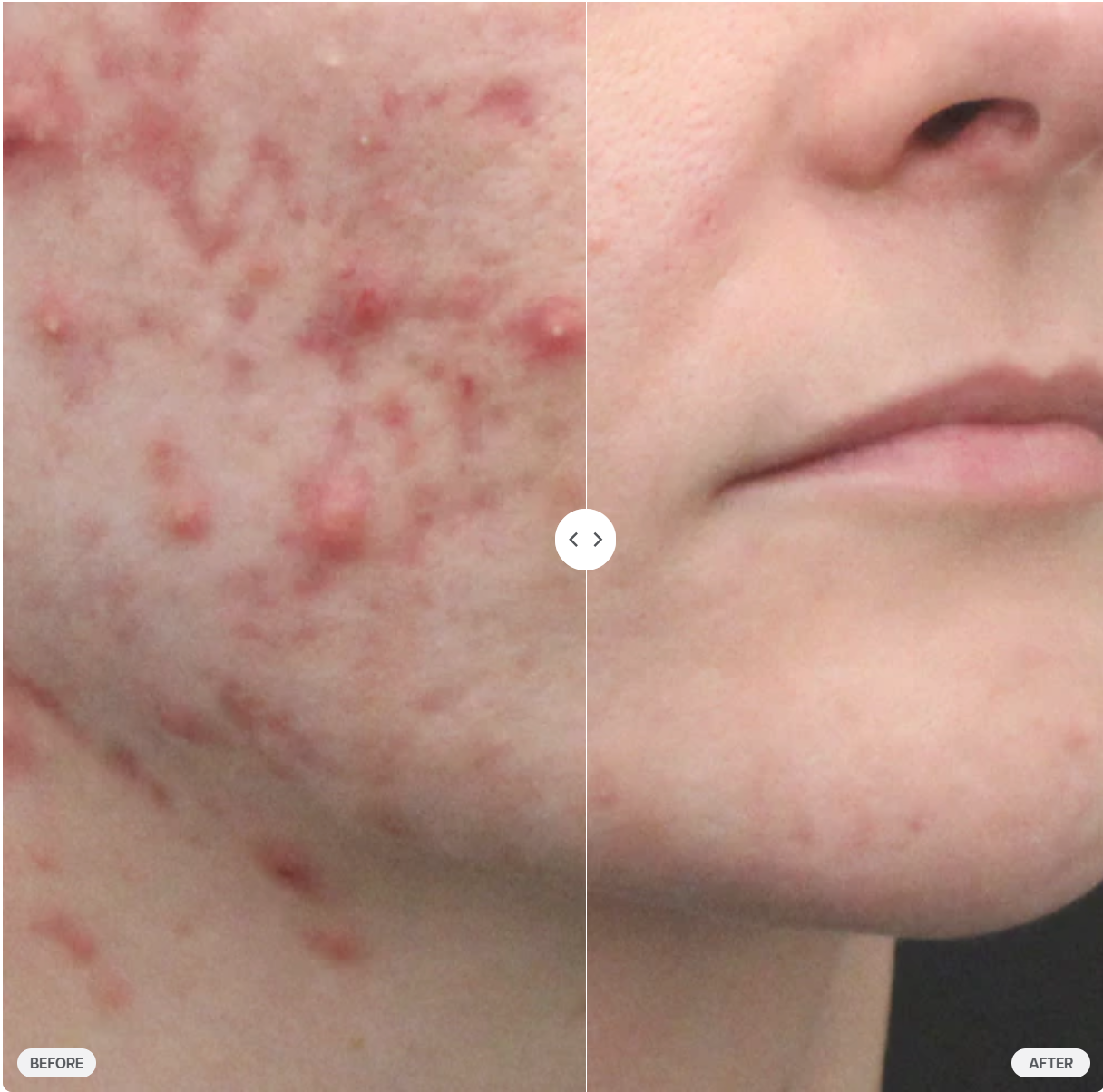 clear skin facial before and after Results by Cecia Ferin, LE . Results achieved using customized Face Reality® professional treatments and home care regimen protocol over a period of 16 weeks. Clinical photos are unretouched. Individual results may vary depending on adherence to protocol.